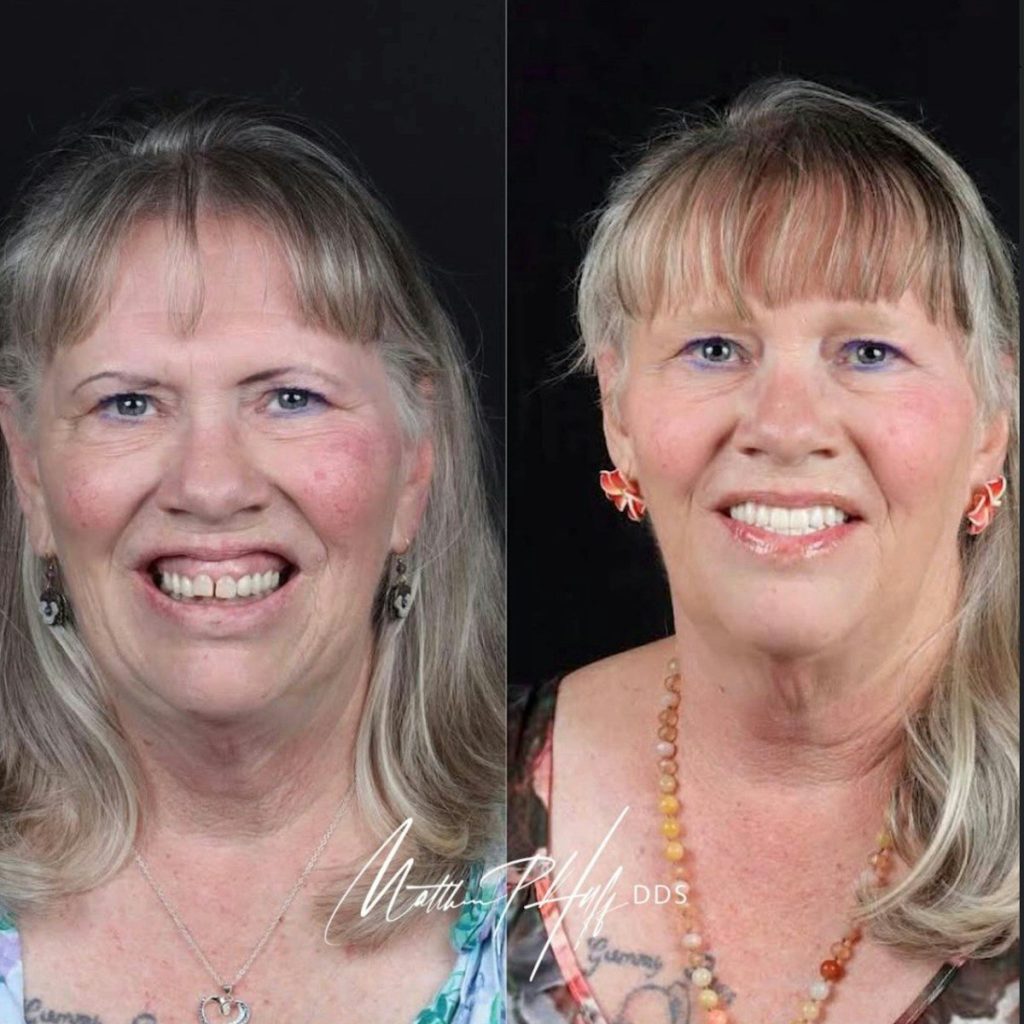 Woman before and after Veneers.